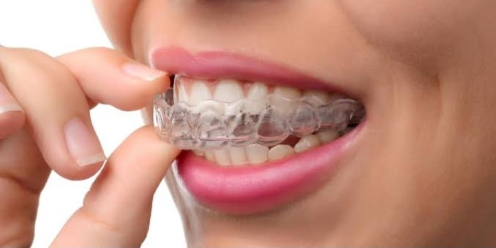 FAQs on Invisalign, the Best New Braces